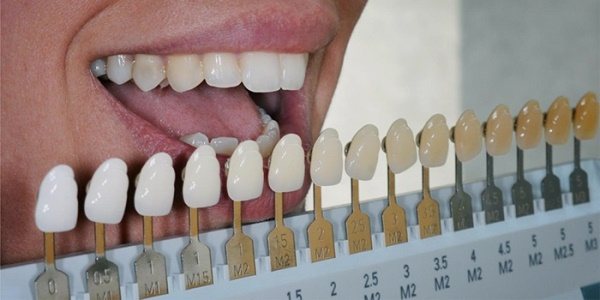 لماذا تفقد الأسنان بياضها؟.. الأسباب وطرق استعادتها